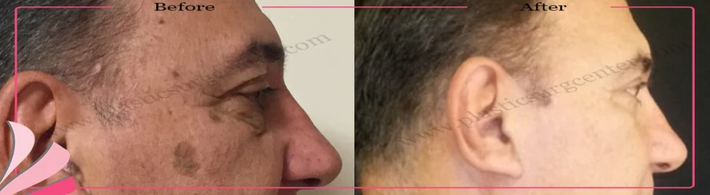 Upper and lower eyelid surgery - case 21 - Right Profile