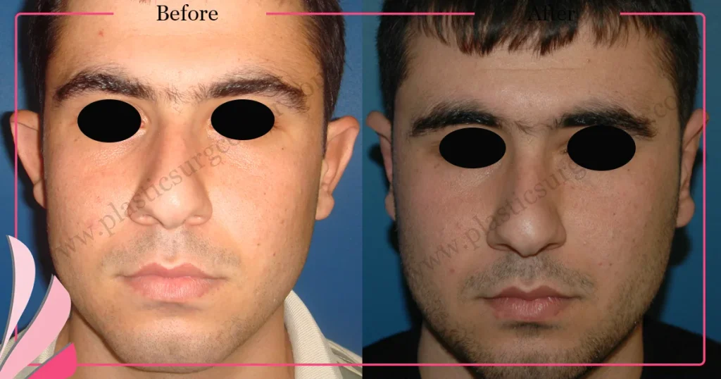 Otoplasty, Prominent ear surgery - Case 5 - Front View