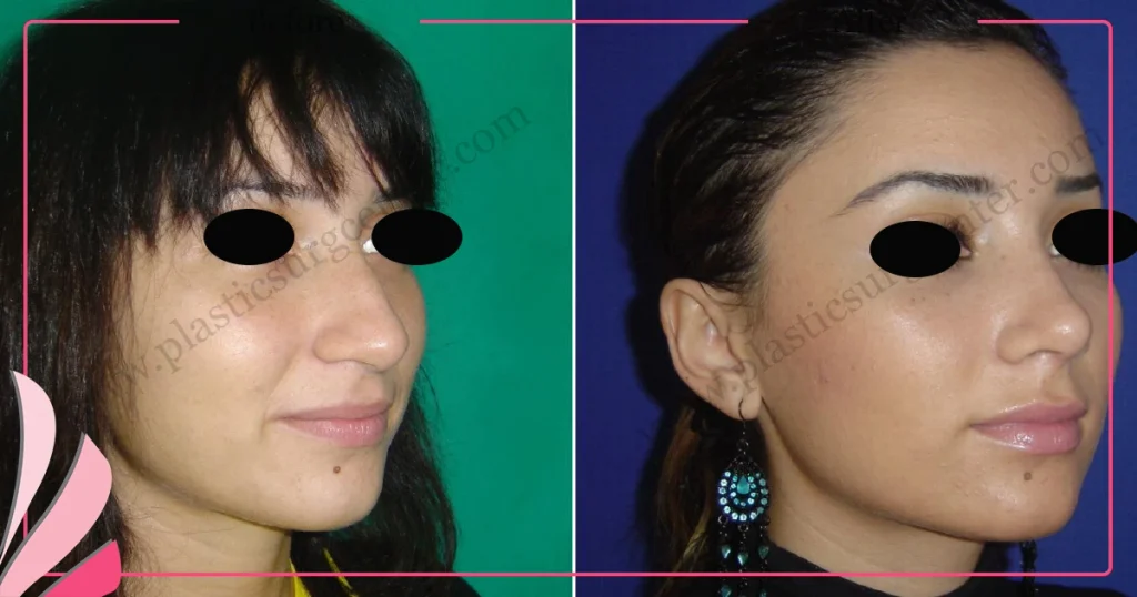 Rhinoplasty in Turkey - Case 23 - Female - Oblique View
