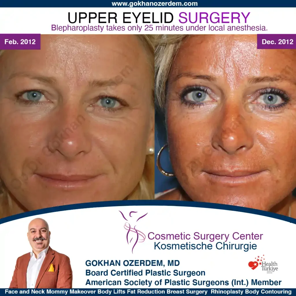 Upper eyelid surgery - case 36 - Front view
