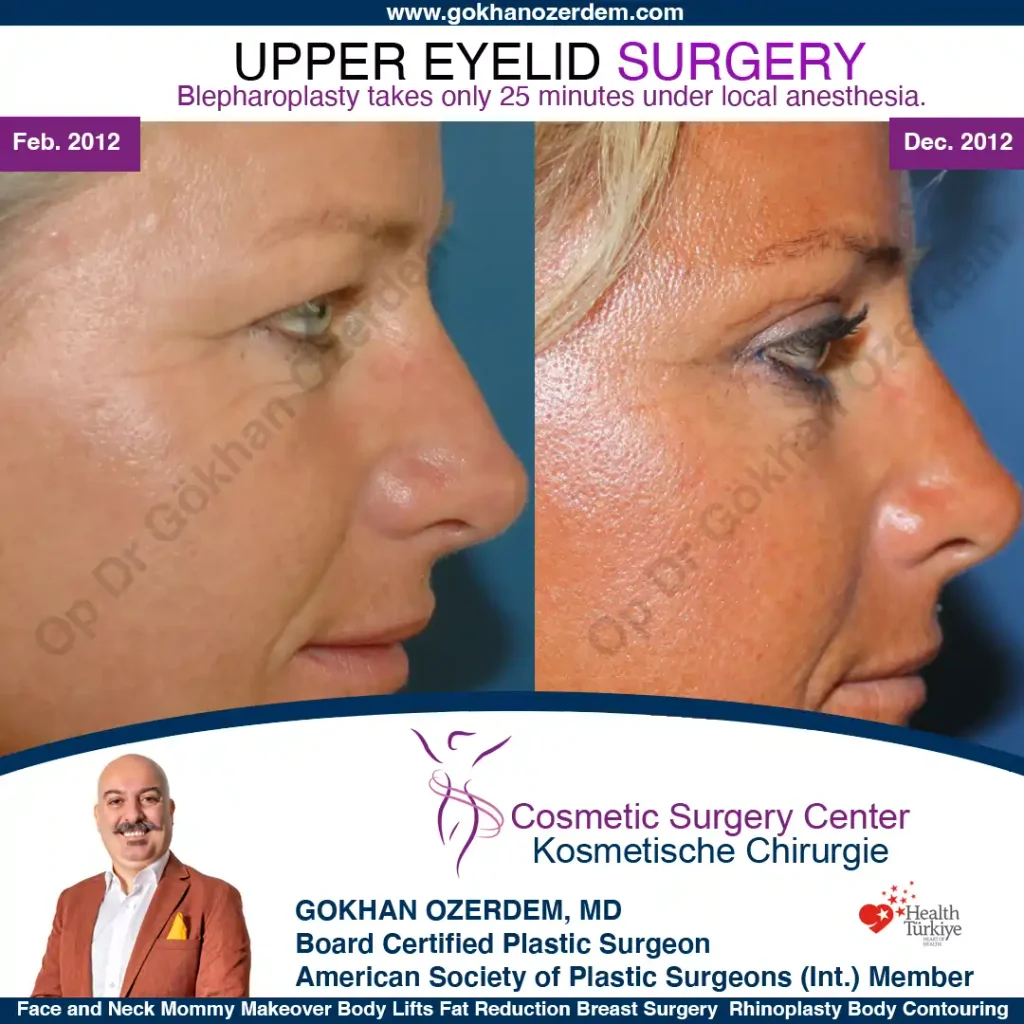 Upper eyelid surgery - case 36 - Right profile