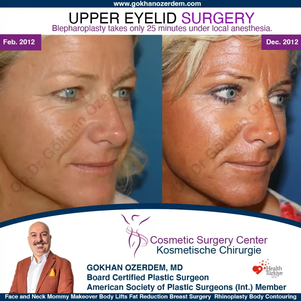 Upper eyelid surgery - case 36 - Oblique view