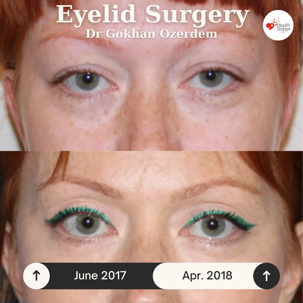 Upper eyelid surgery - case 16 - Front view