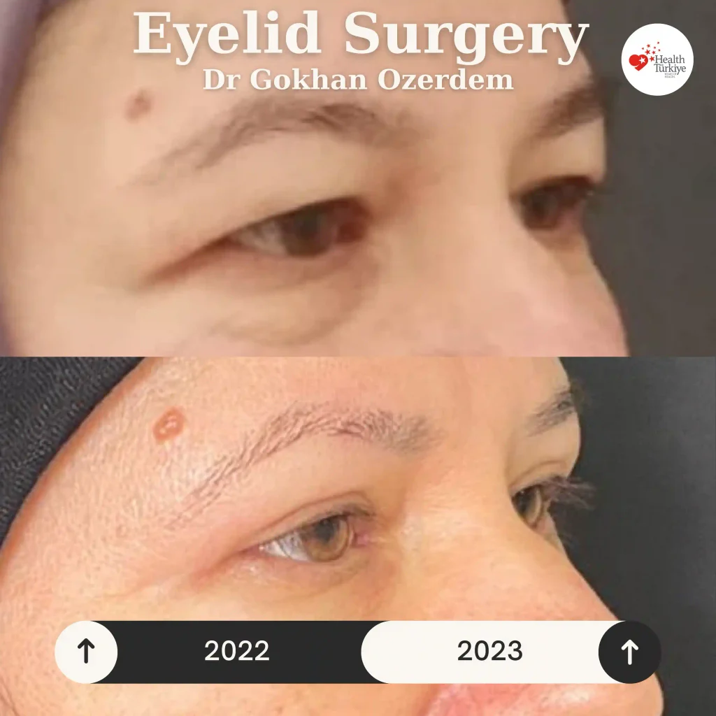 Upper eyelid surgery - case 6 - Oblique view