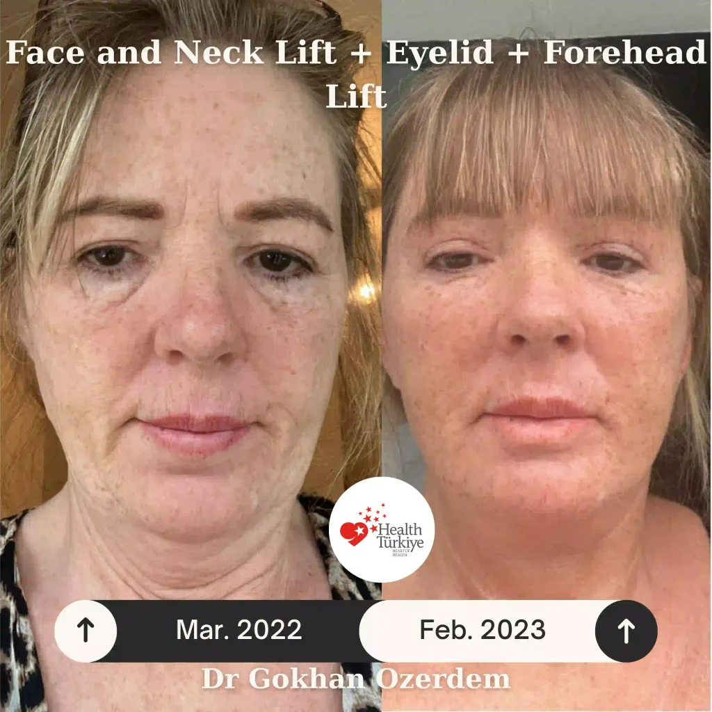 Upper Lower eyelid surgery - case 12 - Front view