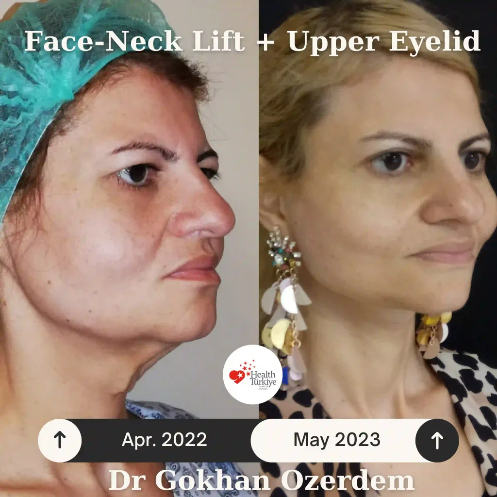 Upper eyelid surgery - case 13 - oblique view