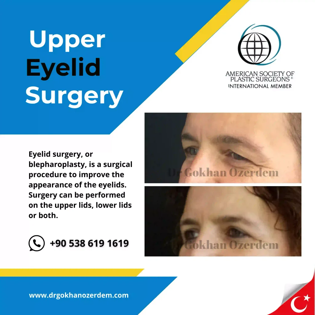 Upper eyelid surgery - case 17 - Oblique view