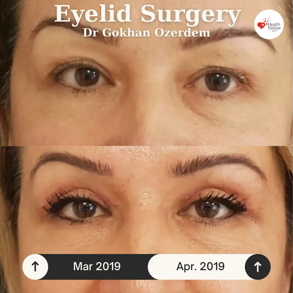 Upper eyelid surgery - case 7 - Front view