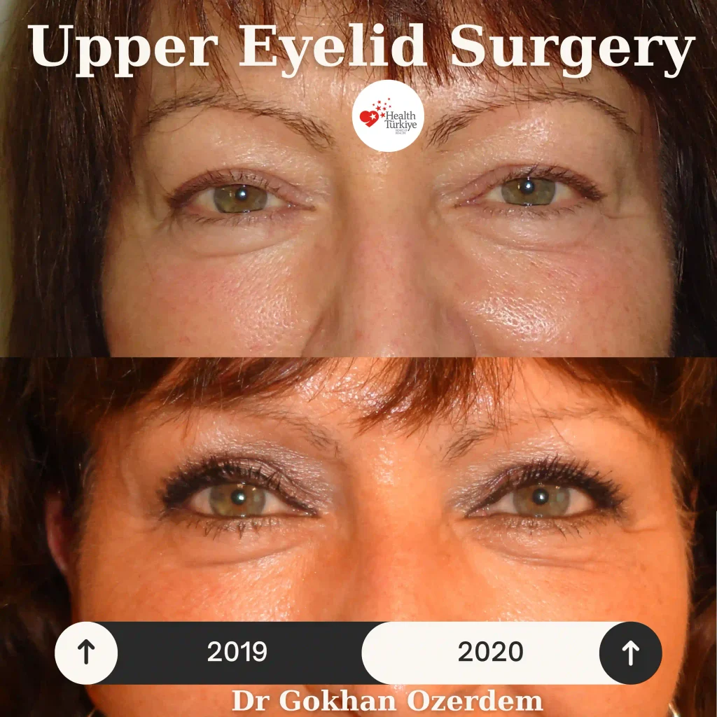 Upper eyelid surgery - case 15 - Front view