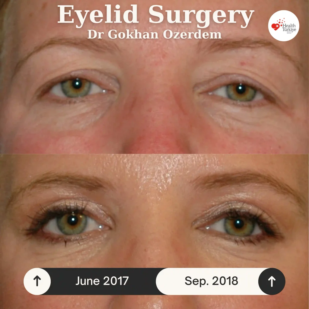 Upper eyelid surgery - case 14 - Front view