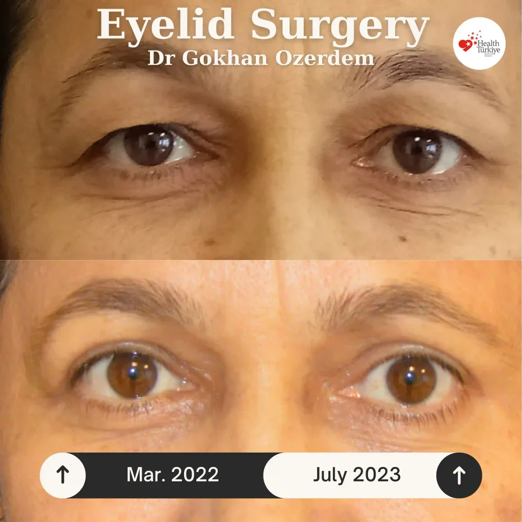 Upper eyelid surgery - case 8 - Front view