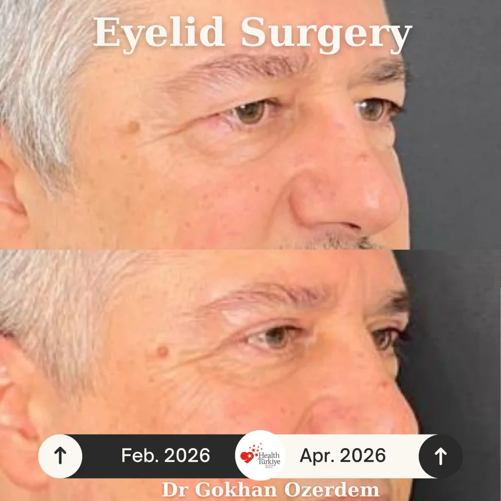 Upper eyelid surgery - case 9 - Oblique view