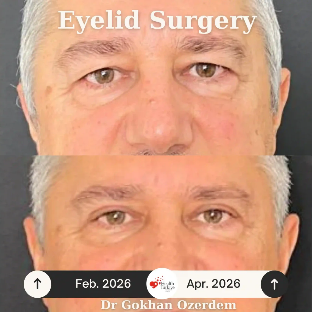 Upper eyelid surgery - case 9 - Front view