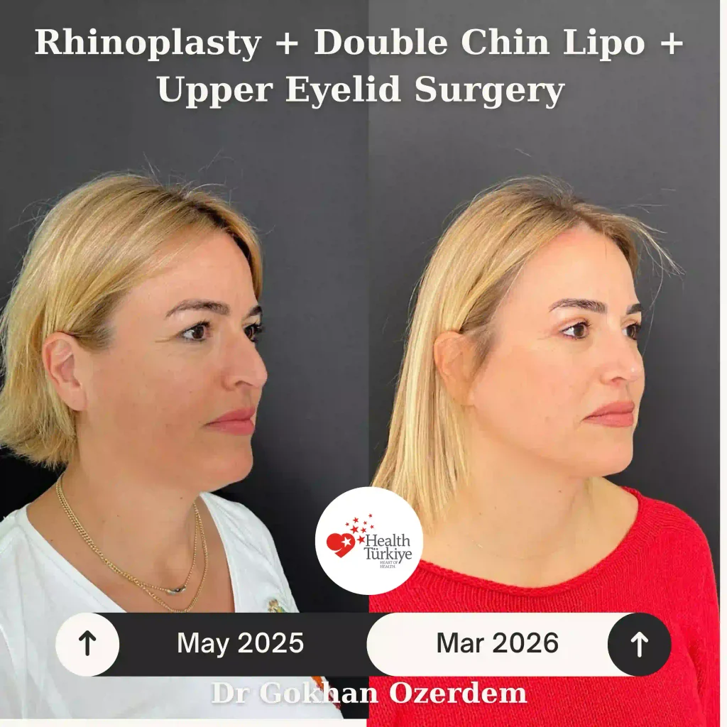 Upper eyelid surgery - case 10 - Right Oblique view