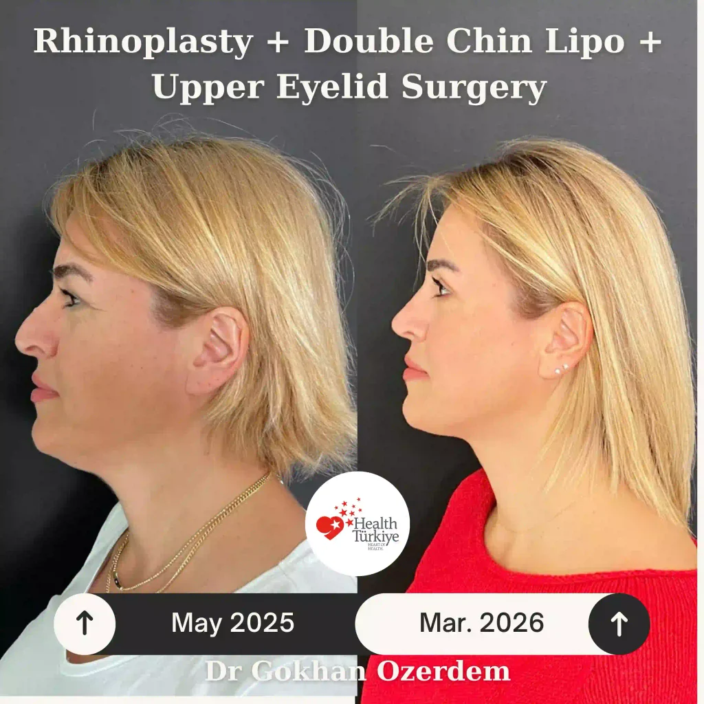 Upper eyelid surgery - case 10 - Left Profile