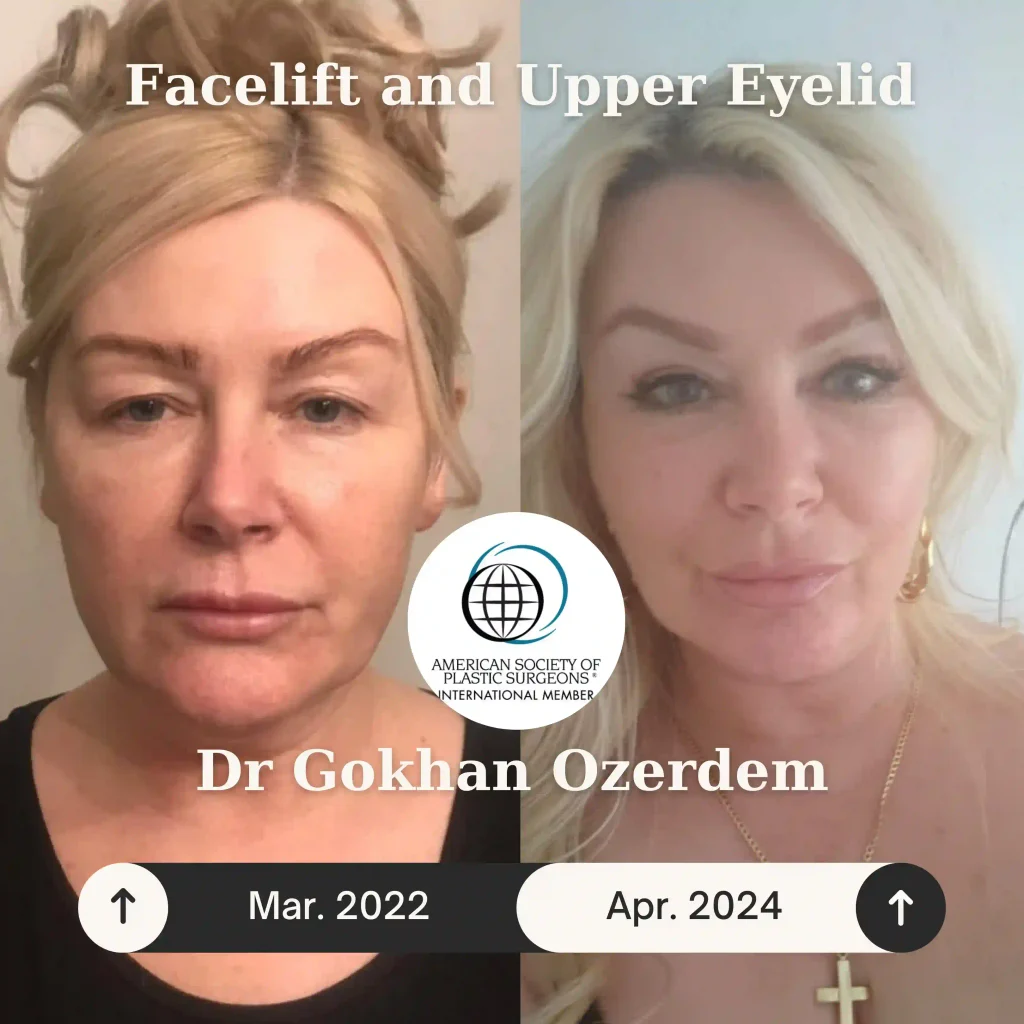Upper eyelid surgery - case 11 - Front view