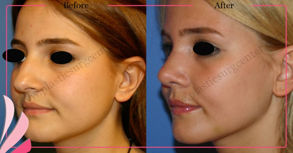 Rhinoplasty in Turkey - Case 22 - Female - Oblique View