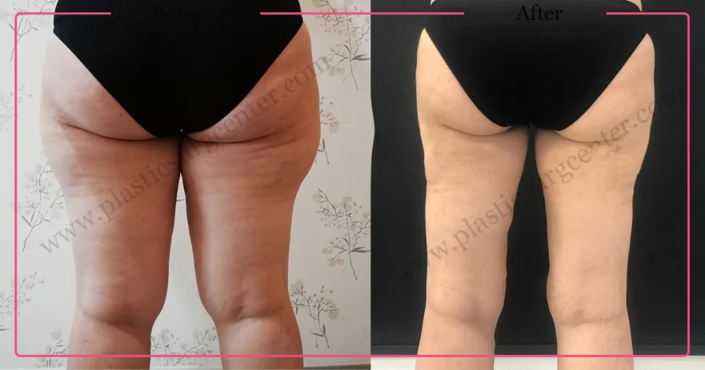 Leg Liposuction in Turkey - Case 3 - Back view