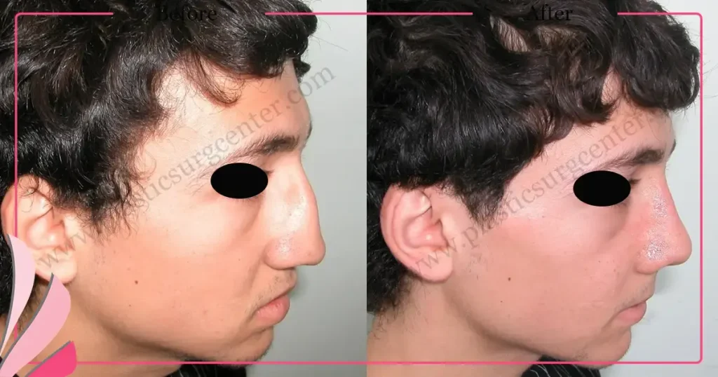 Rhinoplasty in Turkey - Case 21 - Male - Right Profile