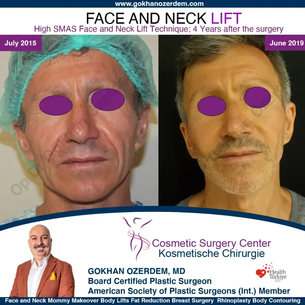 Facelift before and after - Case 8, Front View