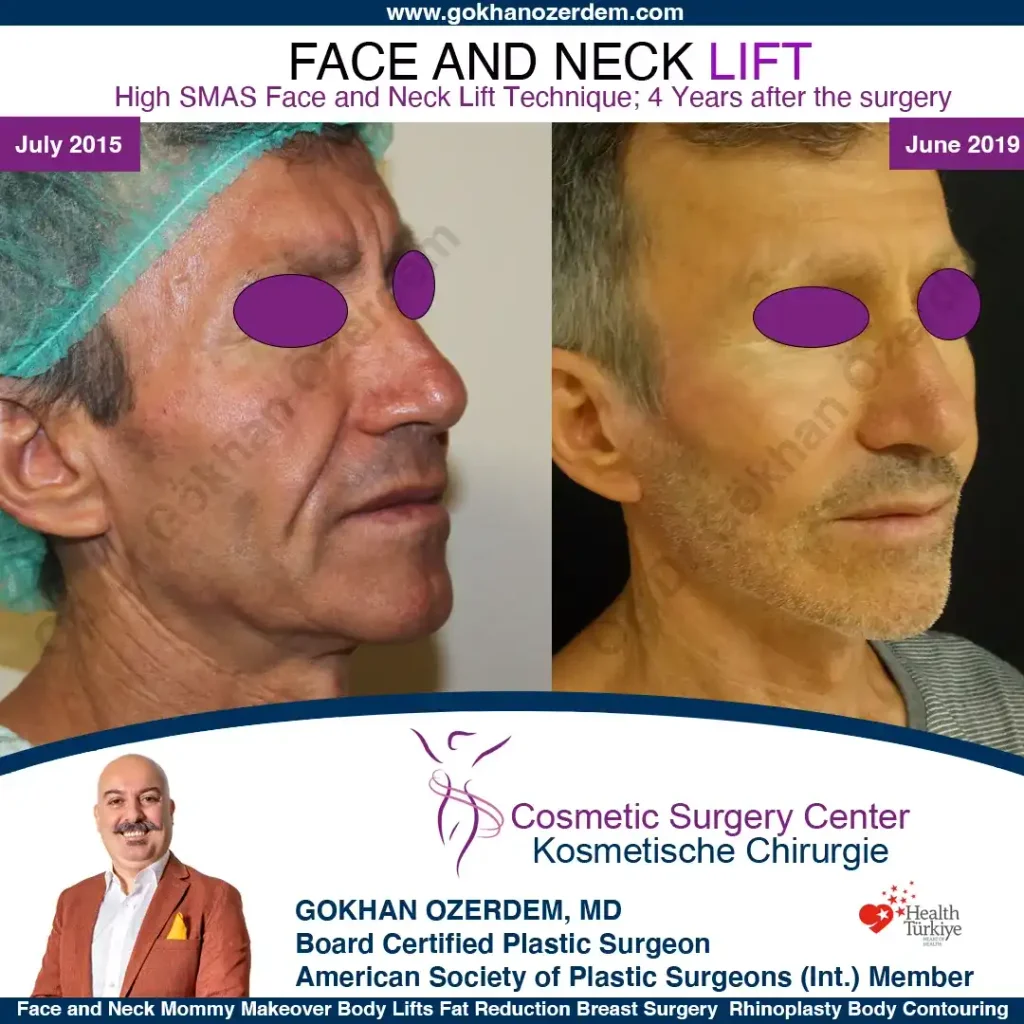 Facelift before and after - Case 8, Right Profile