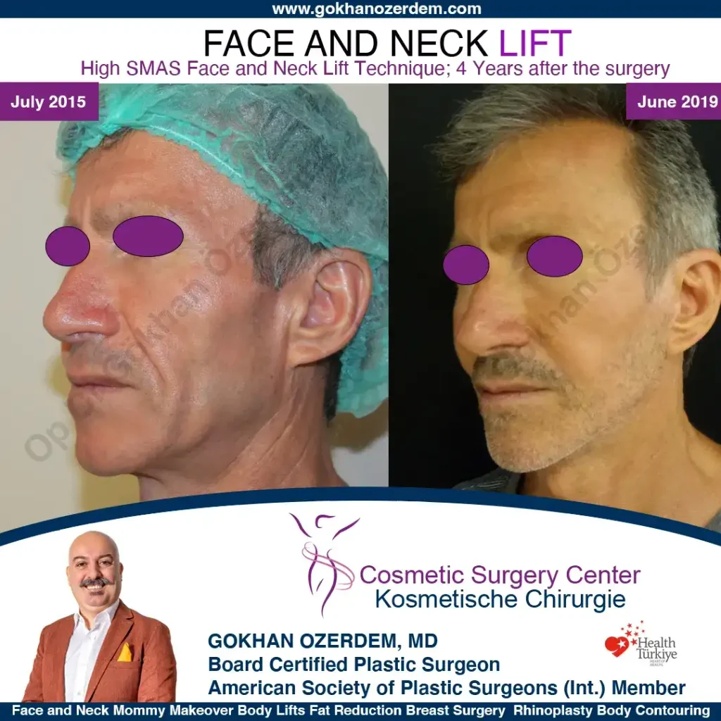 Facelift before and after - Case 8, Oblique view
