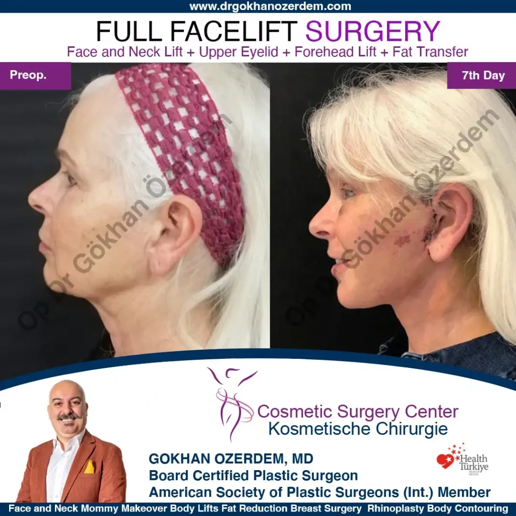 Facelift before and after - Case 11, Left Profile