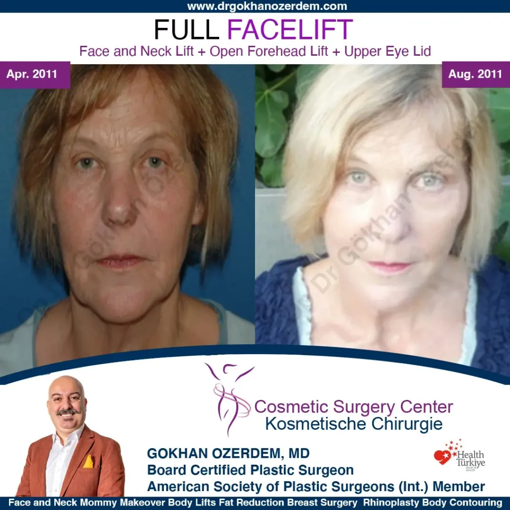 Facelift before and after - Case 10, Front View
