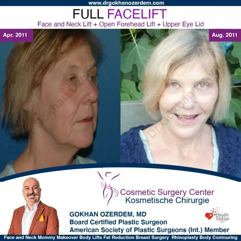 Facelift before and after - Case 10, Oblique view