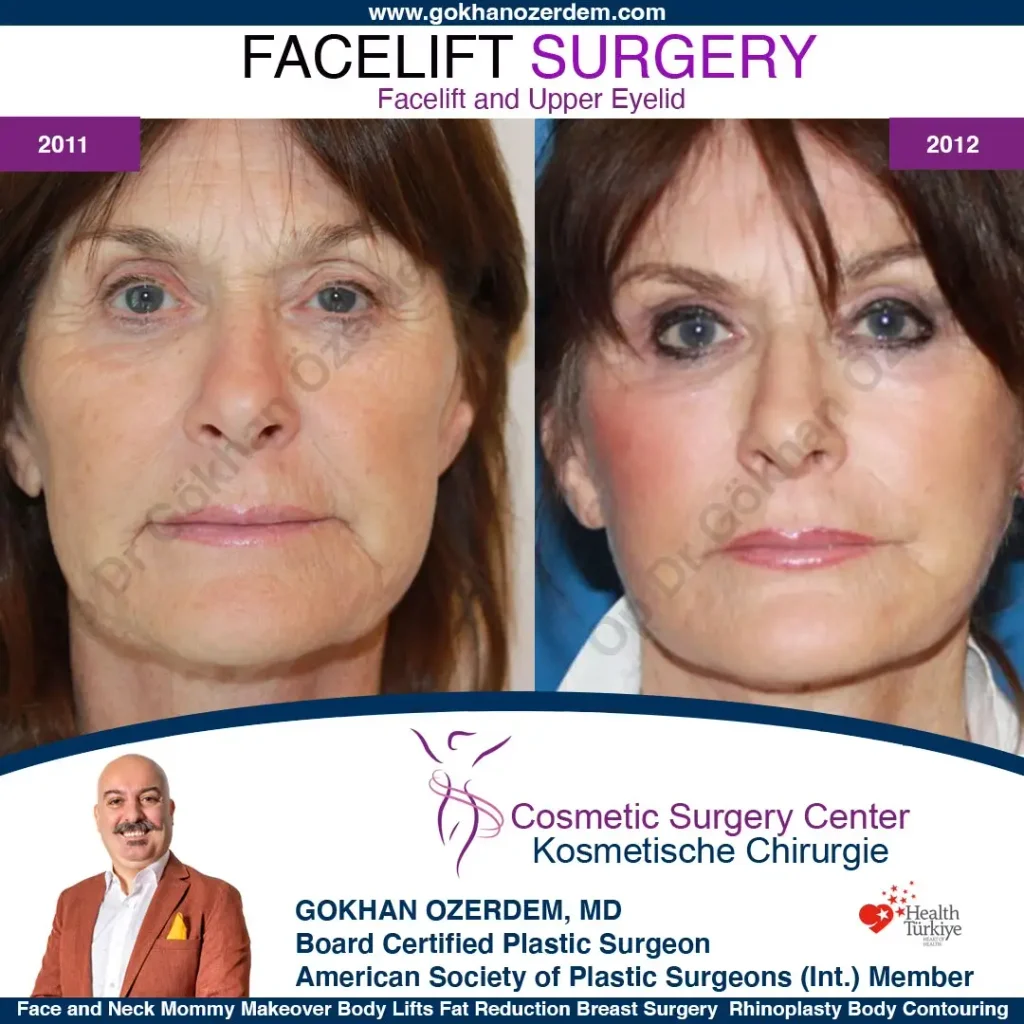 Facelift before and after - Case 9, Front View