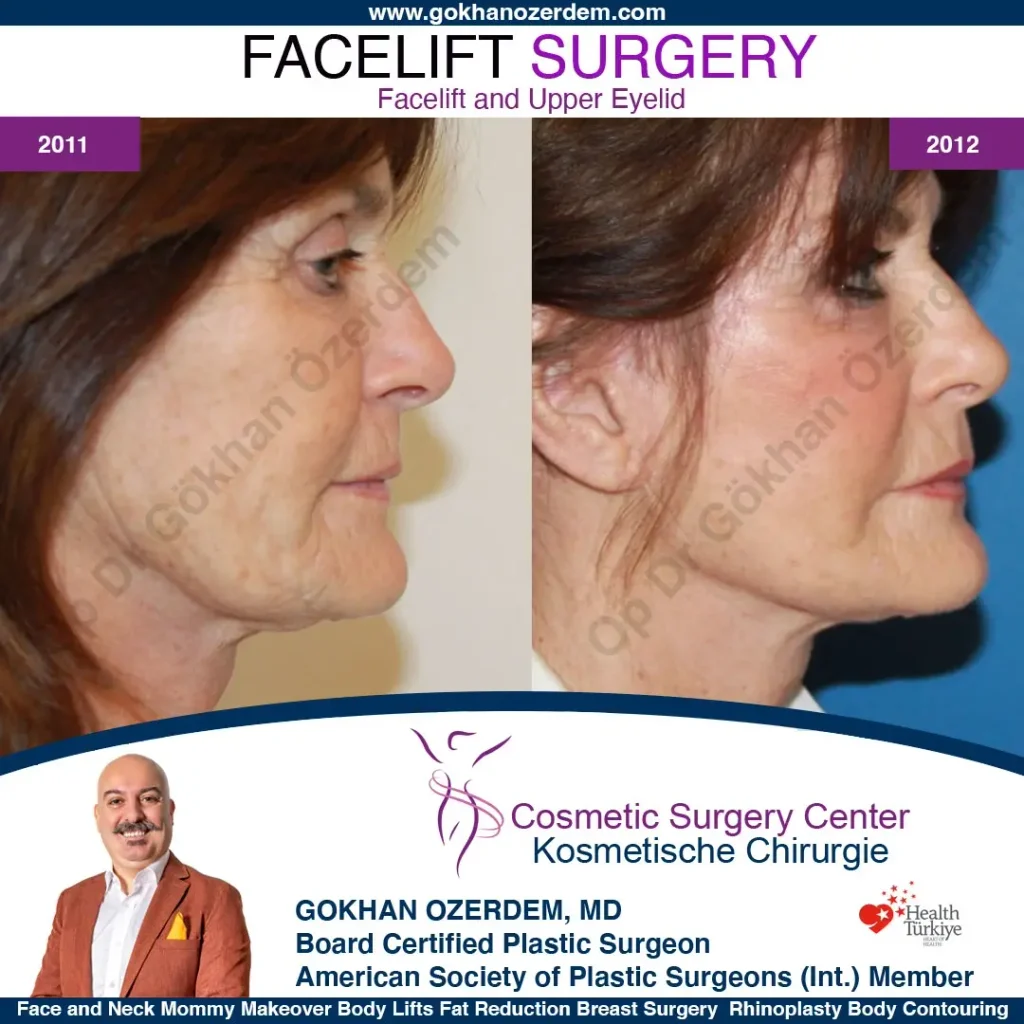 Facelift before and after - Case 9, Right Profile