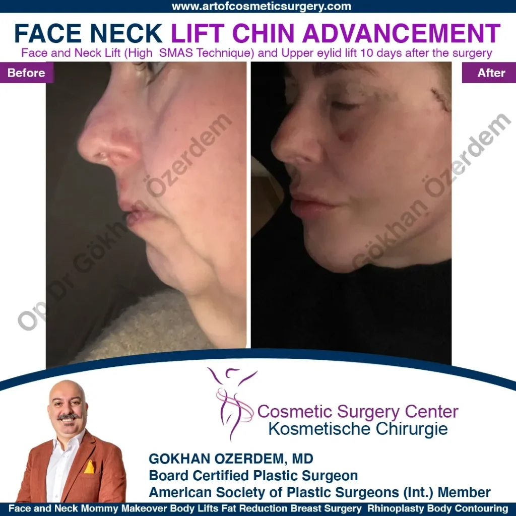 Facelift before and after - Case 12, Left Profile