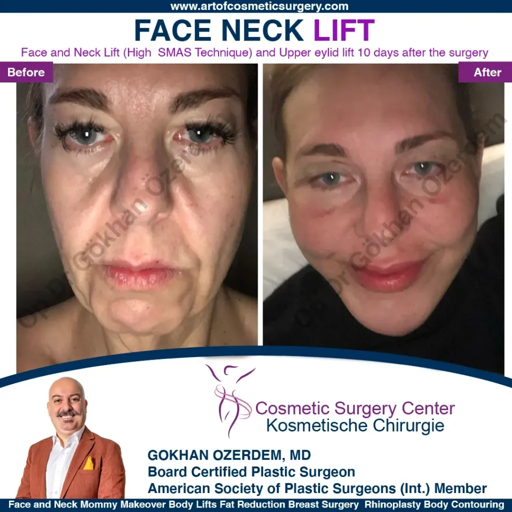 Facelift before and after - Case 12, Front View