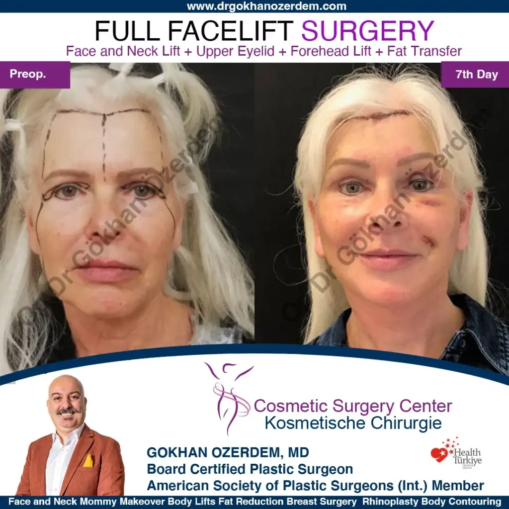 Facelift before and after - Case 11, Front View