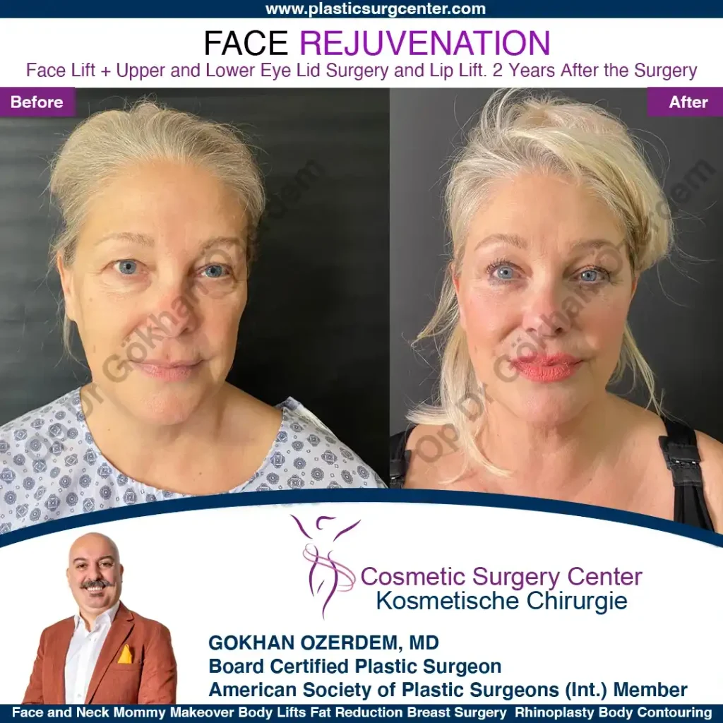 Upper and lower eyelid surgery - case 18 - Front view