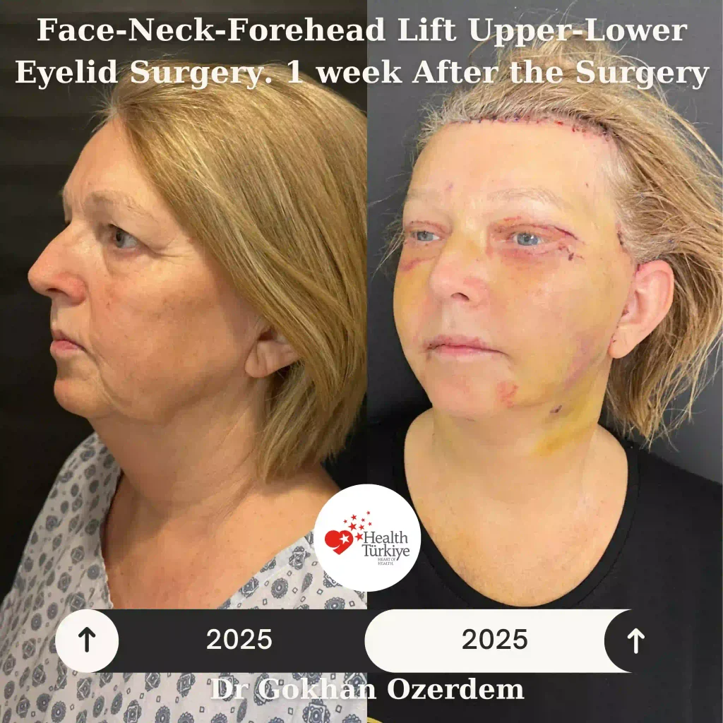 Facelift before and after - Case 14, Oblique view