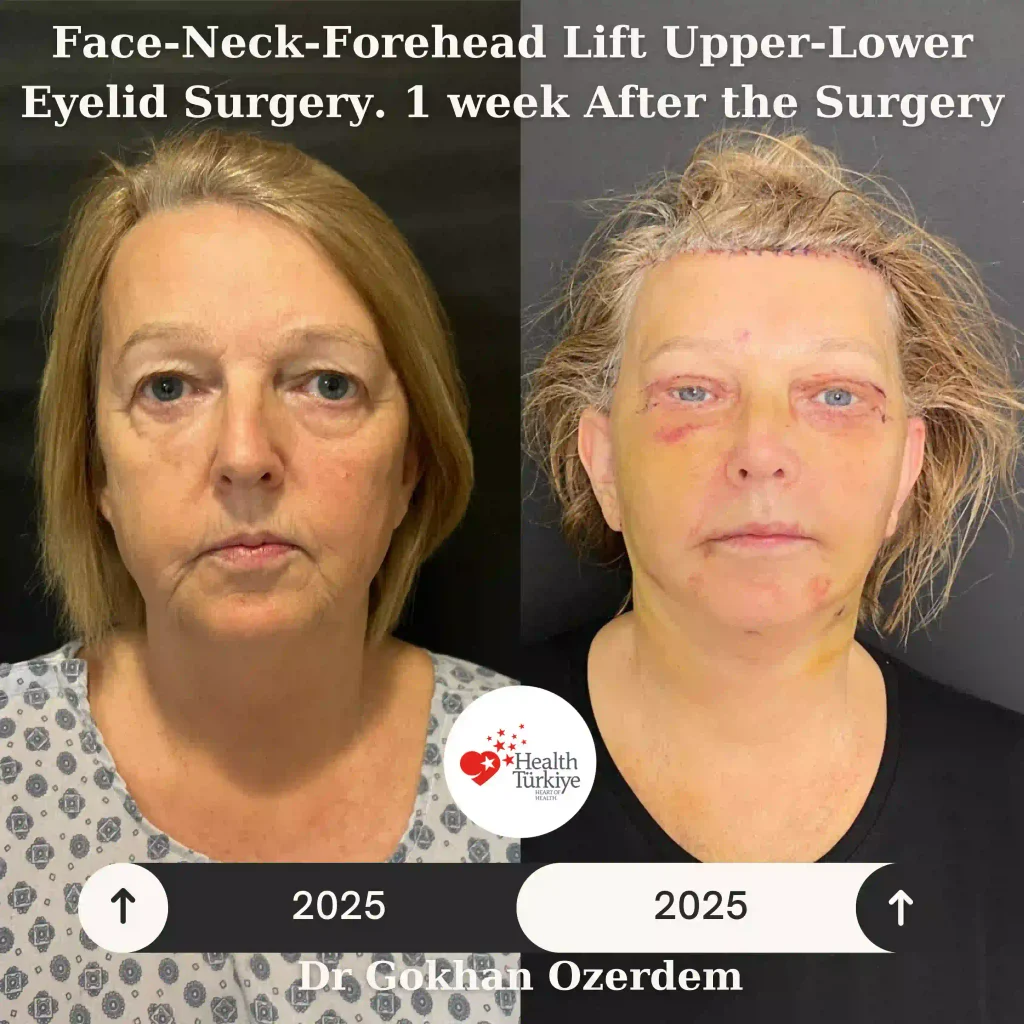 Facelift before and after - Case 14, Front View