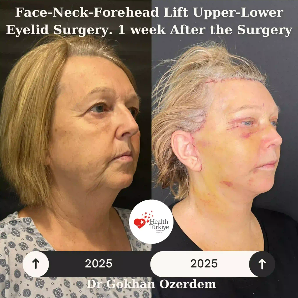 1 week after the full facelift Case 14