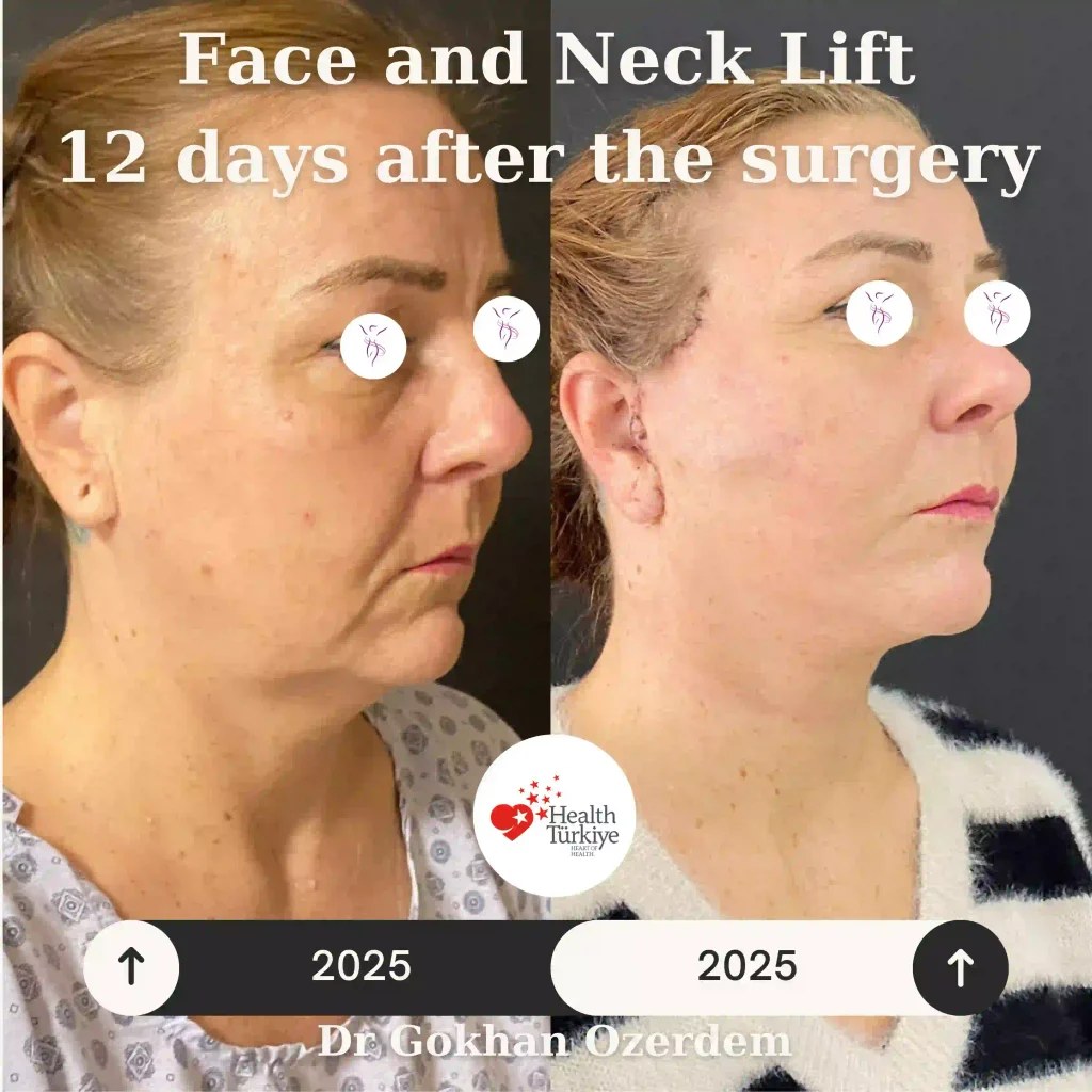 45 years old patient facelift Case 17