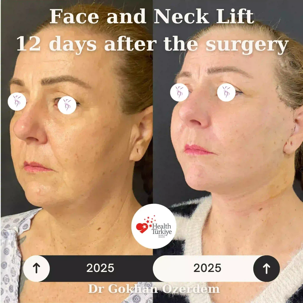 Facelift before and after - Case 17, Oblique view