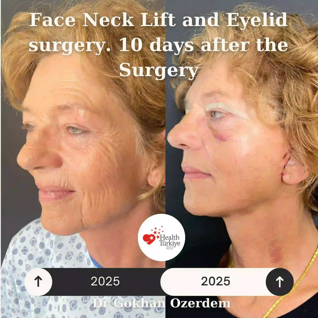 Facelift before and after - Case 16, Oblique view