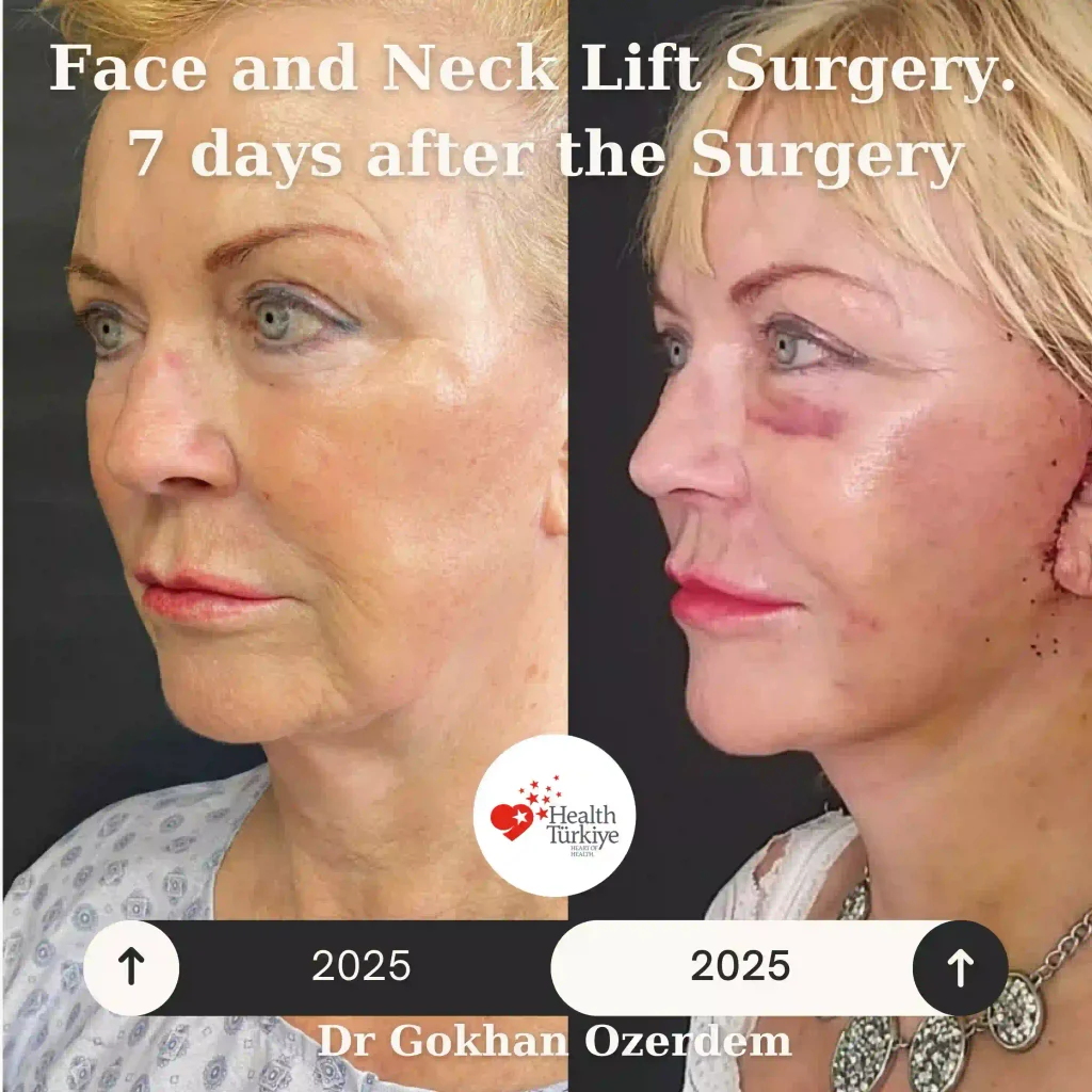 Facelift before and after - Case 15, Oblique view