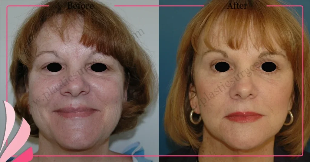 Facelift before and after - Case 20, Front View