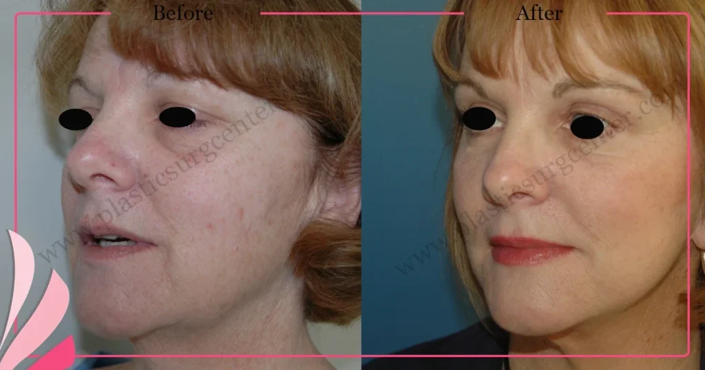 Facelift before and after - Case 20, Oblique view