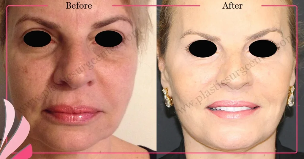 Facelift before and after - Case 21, Front View