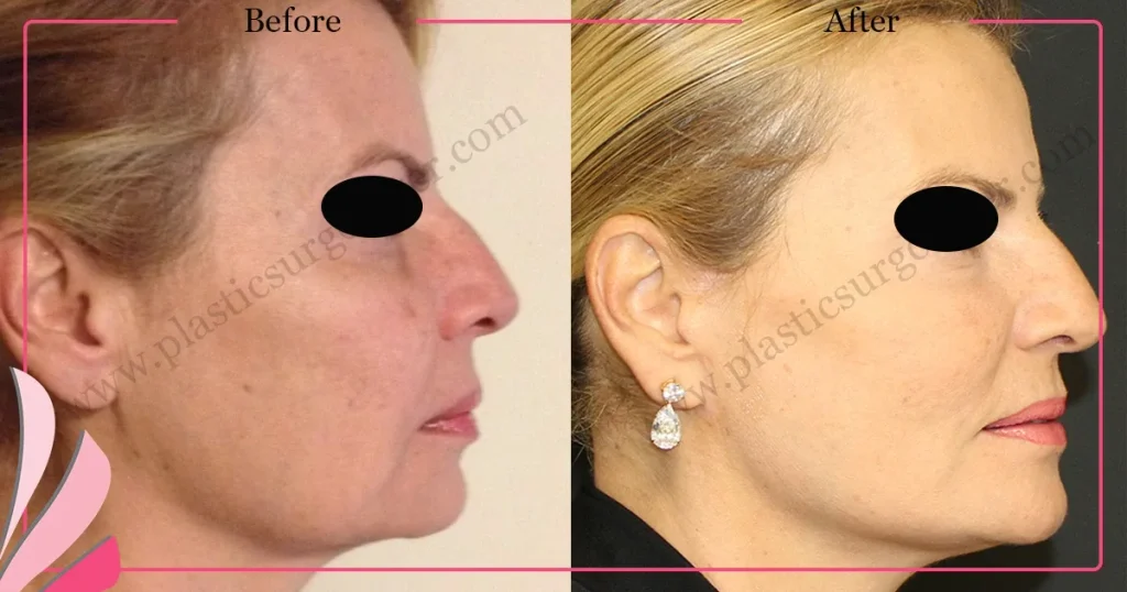 Facelift before and after - Case 21, Right Profile