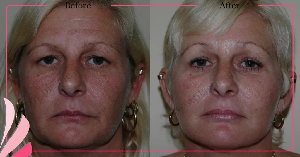 Facelift before and after - Case 22, Front View