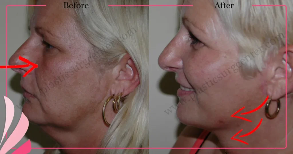 Facelift before and after - Case 22, Left Profile