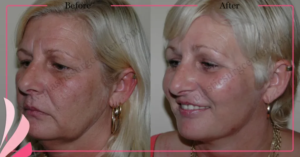 Facelift before and after - Case 22, Oblique view