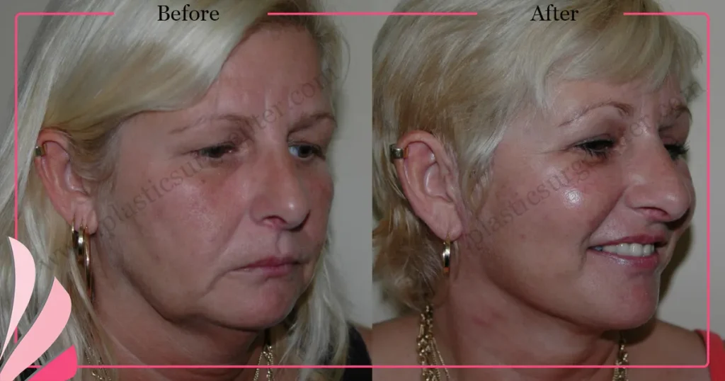 Facelift before and after - Case 22, Right Oblique view